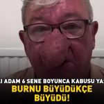 Burnu büyüdükçe büyüdü! 68 yaşındaki adam kabusu yaşadı! 4 saatlik operasyonla adeta yeniden doğdu